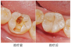 蛀牙补牙需要多少钱